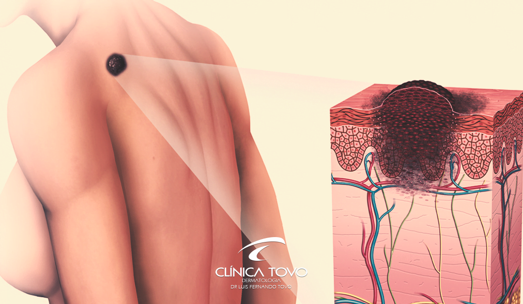 Tipos de Câncer da Pele