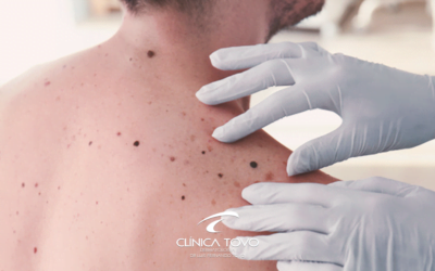 Informações sobre o Melanoma