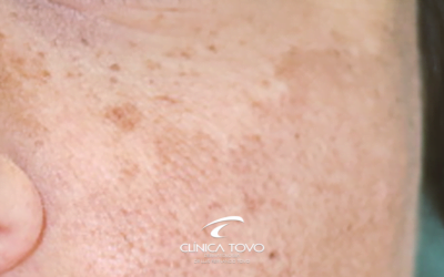 Novidades em Dermatologia Meeting AAD Fevereiro 2018 Melasma