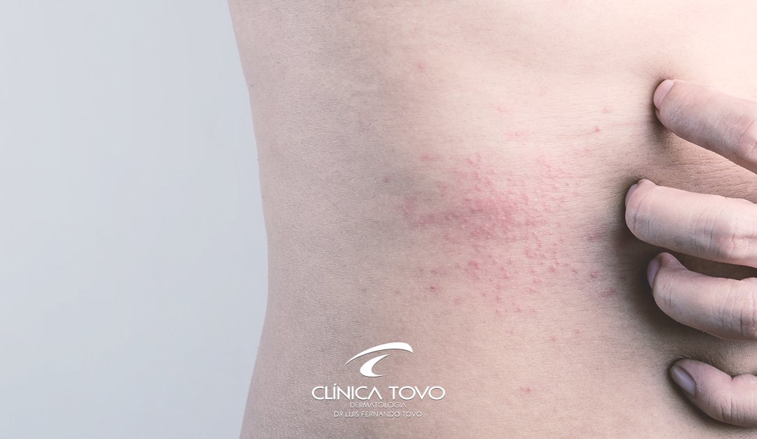 Dermatite Atópica – Nova Droga para Controle