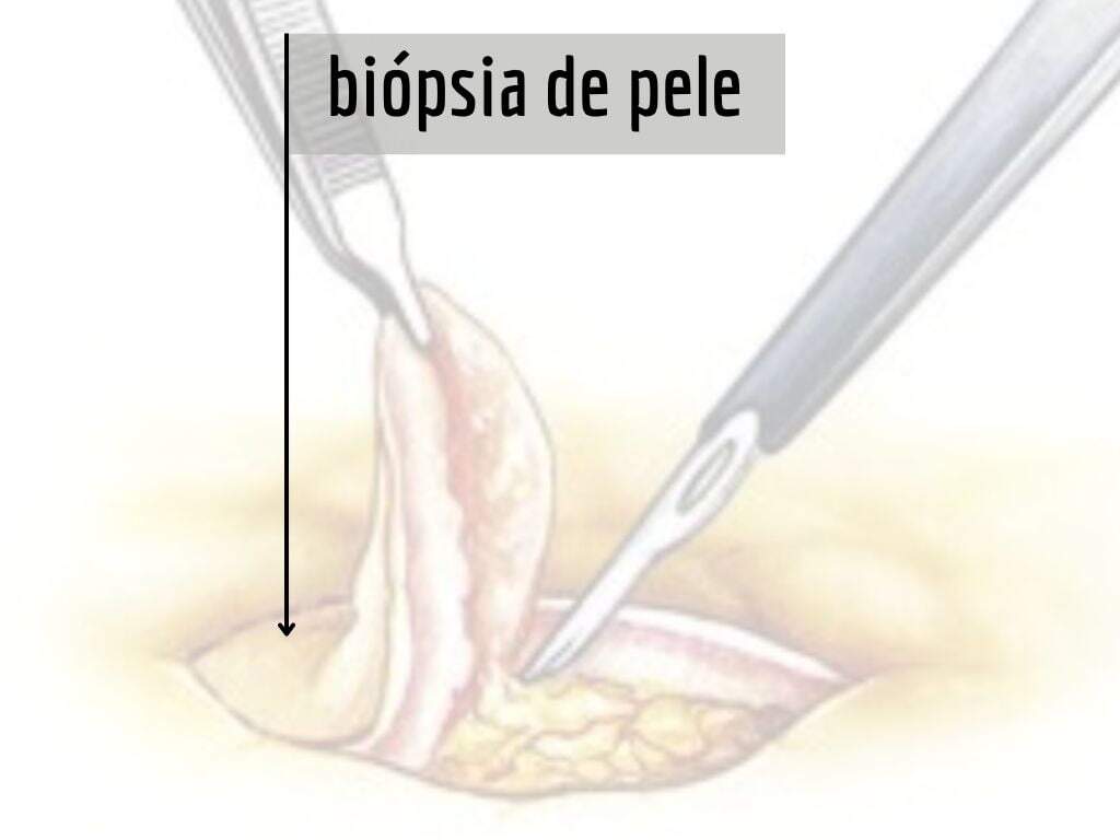 biopsia de pele sirio libanes tovo