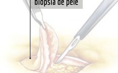 BIÓPSIA DE PELE: qual a finalidade da biópsia da pele?